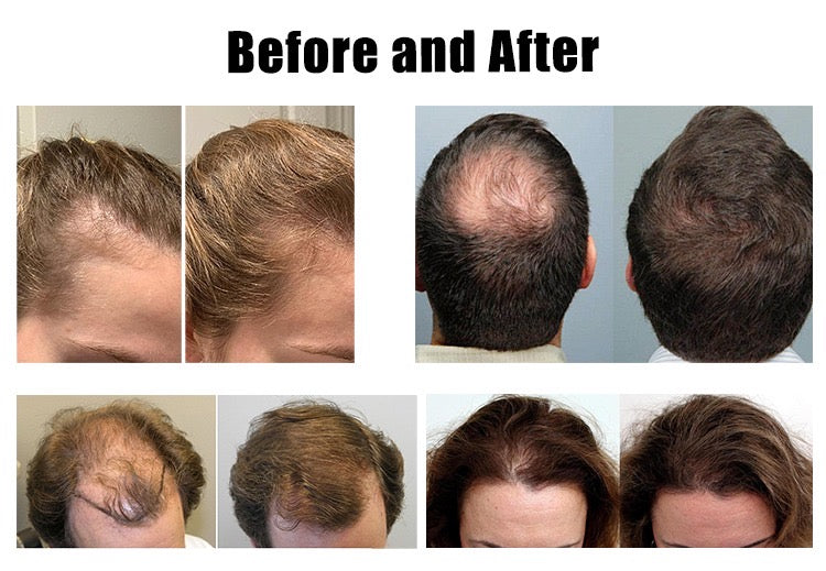 EMANA® HairLux™ LED Hair Regrowth Therapy Cap | Red & Blue Light Scalp Therapy