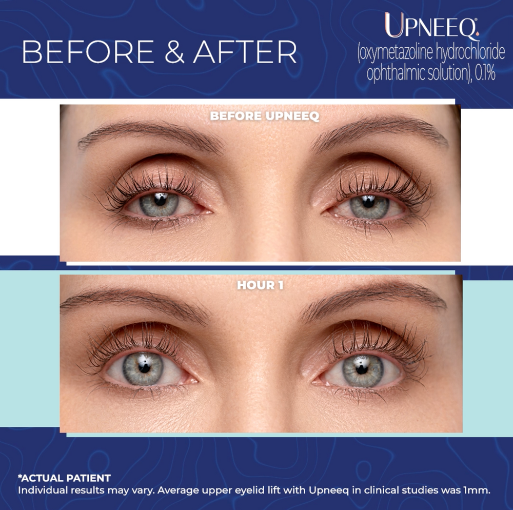 UPNEEQ Eye Drops