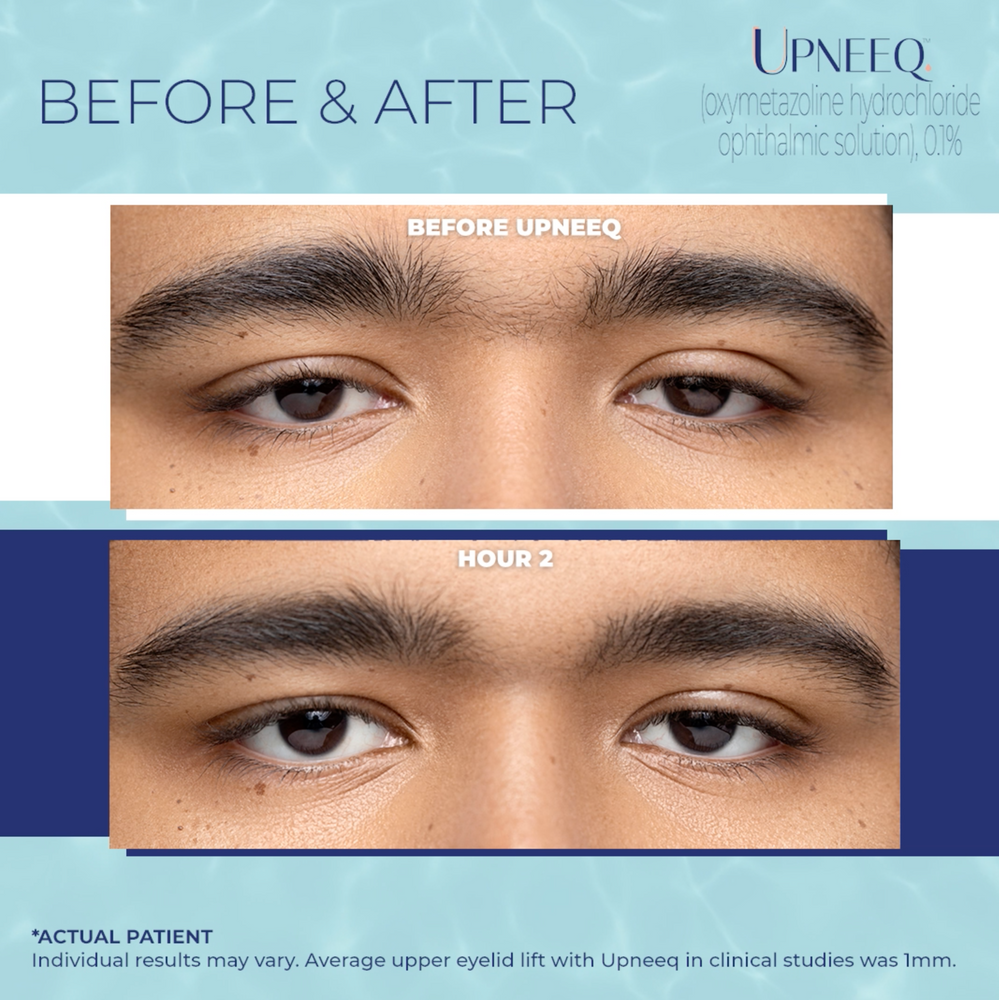 UPNEEQ Eye Drops