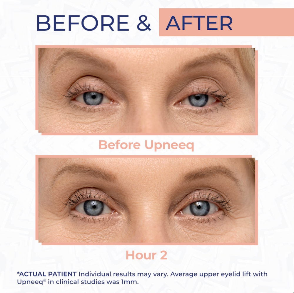 UPNEEQ Eye Drops