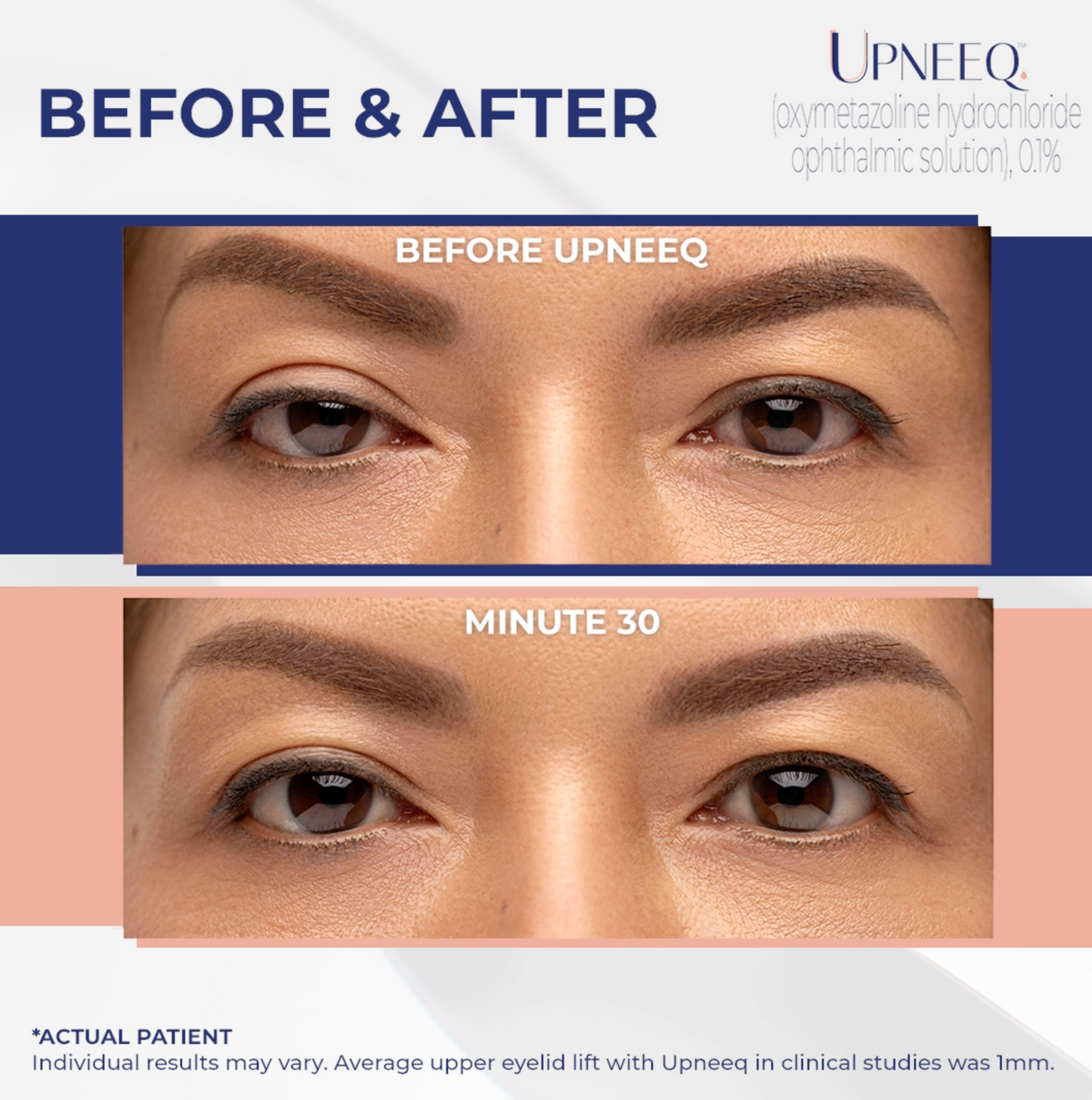 UPNEEQ Eye Drops